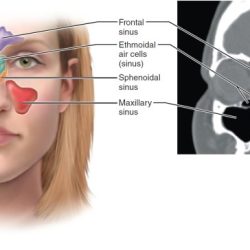 Sinuses anatomy diagram maxillary sinus head sinusitis maxilla surgery bone solstice winter 2010