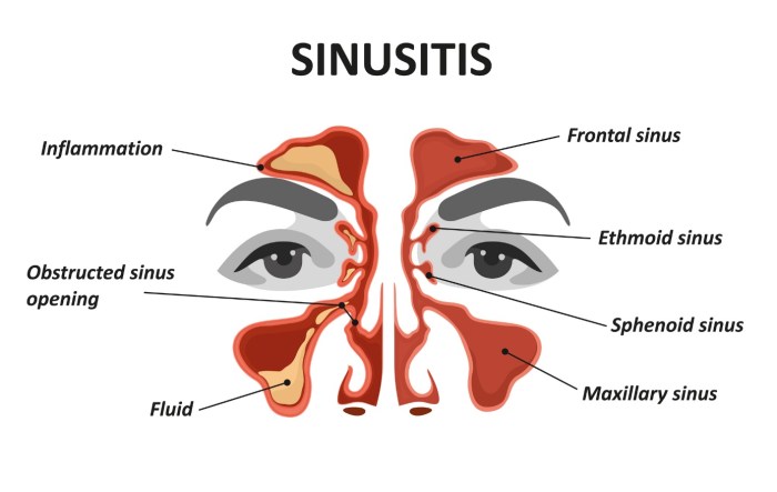 Sinusotomy four sinuses unilateral cpt code